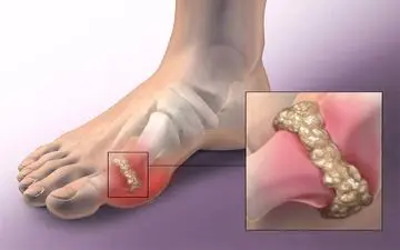 نقرس چیست و چه درمانی دارد؟