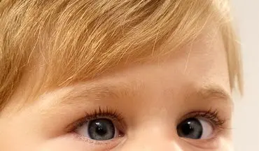  رایج‌ترین دلیل نارسایی بینایی در کودکان