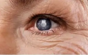 جراحی،تنها درمان آب مروارید؟