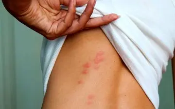 تکنیک های ساده برای درمان جوش های پشت