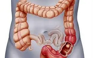 سرطان روده| عوامل خطر سرطان روده و راه‌های پیشگیری از این بیماری ذت بشناسید