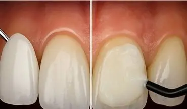 لمینت و کامپوزیت برای چه کسانی مناسب نیست؟