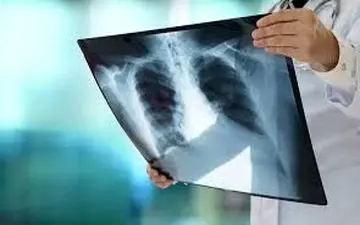 چطور مطمئن شویم ریه‌هایمان درگیر "کرونا" شده است؟