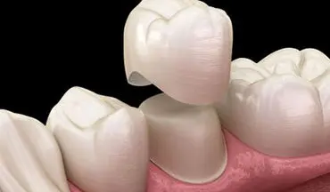 با عفونت دندان روکش شده چه باید کرد؟ | علت عفونت دندان روکش شده | علائم عفونت دندان روکش شده