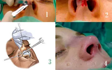 نحوه انجام جراحی بینی به روش باز