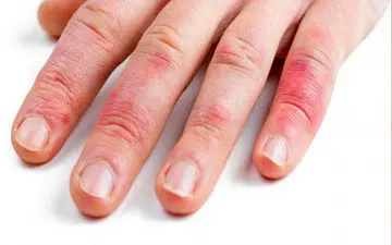 حساسیت به لاتکس چیست؟ علائم آلرژی به لاتکس 