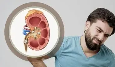 درد سنگ کلیه شما را کلافه کرده است این نوشیدنی ها مختص شماست
