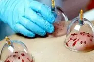 از سردرد تا فشار خون/ معجزه حجامت زیر ذره‌بین