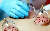 از سردرد تا فشار خون/ معجزه حجامت زیر ذره‌بین