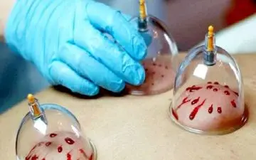 از سردرد تا فشار خون/ معجزه حجامت زیر ذره‌بین