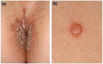 چه عواملی باعث ابتلای دختران مجرد به زگیل تناسلی می شود؟