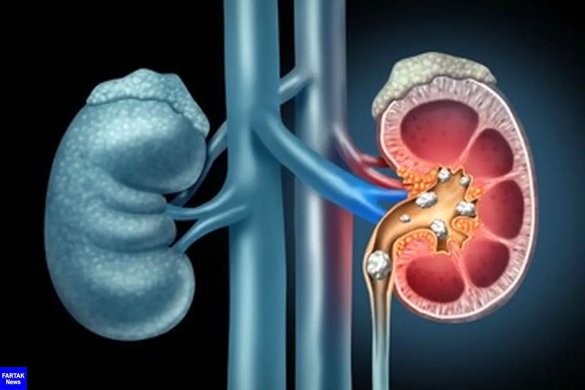 تغذیه مناسب مبتلایان به «سنگ کلیه» 

