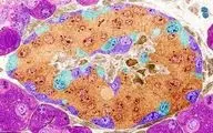 ویرایش ژن، امیدی تازه برای درمان دیابت نوع یک