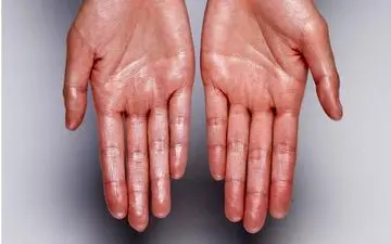 کمبود این ویتامین ها با عرق دست مشخص می شود