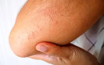 درمان جوش گرمازدگی با مواد طبیعی و روش خانگی مؤثر