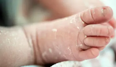 پوست ریزی نوزاد چیست؟