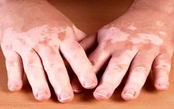 لکه‌های سفید روی پوست نشانه به چه علت است؟

