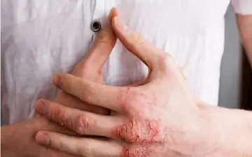 مشکلات پوستی؛شایع ترین بیماری های رایج پوستی در فصل بهار