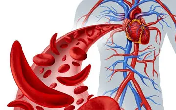 علائم کمبود آهن در بدن چیست؟