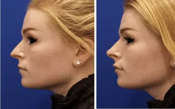 ترمیم افتادگی بینی بعد از عمل