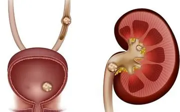 دو دشمن کلیه‌ را بشناسید