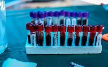 پنج شاخص خونی که مشکلات جدی سلامتی را نشان می‌دهند