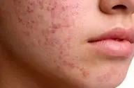 اگر از جوش صورت خسته شدید این مطلب به شما کمک میکند!