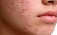 اگر از جوش صورت خسته شدید این مطلب به شما کمک میکند!