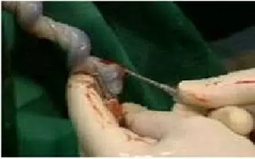 فواید مهم خون بند ناف| حتما بخوانید