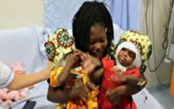 جداسازی موفقیت آمیز خواهران دوقلو با جمجمه متصل به هم 