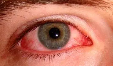 دلیل قرمز شدن چشم ها چیست؟