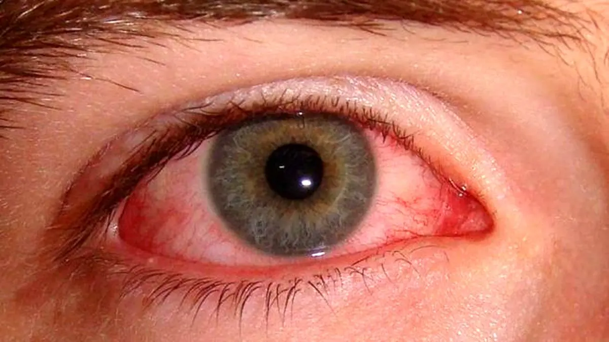 دلیل قرمز شدن چشم ها چیست؟