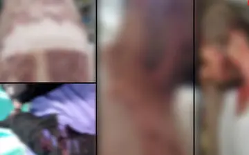 انفجار هولناک نارنجک دستی در دستان 2 نوجوان قمی + آخرین وضعیت مصدمان
