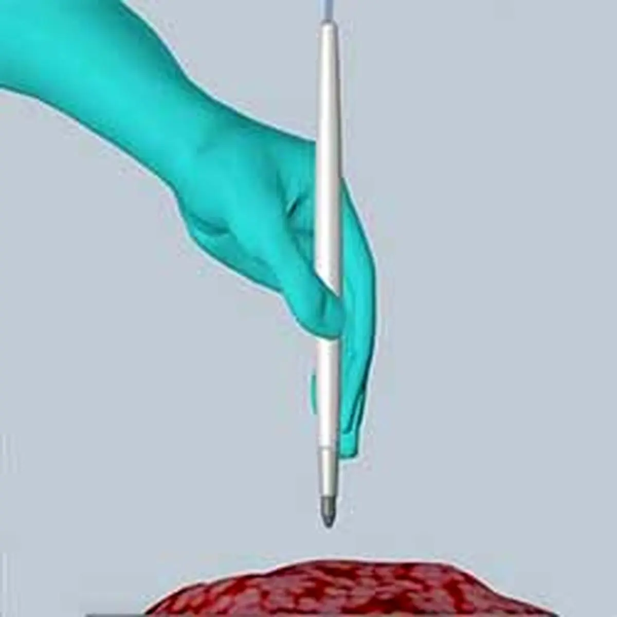  جدیدترین روش تشخیص سرطان در چند ثانیه با یک دستگاه قلمی شکل!