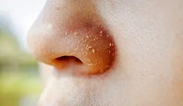 پوسته پوسته شدن روی بینی| دلیل پوسته پوسته شدن روی بینی چیست؟