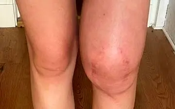 علایم یکی از سرطان‌های مرگبار کودکان را بشناسید

