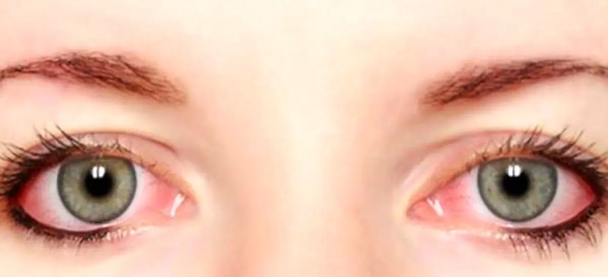 لکه های خونی در چشم چه علتی دارد؟