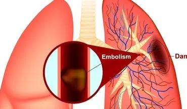 آیا این علائم را دارید؟ آمبولی ریه را جدی بگیرید! (اینفوگرافیک)