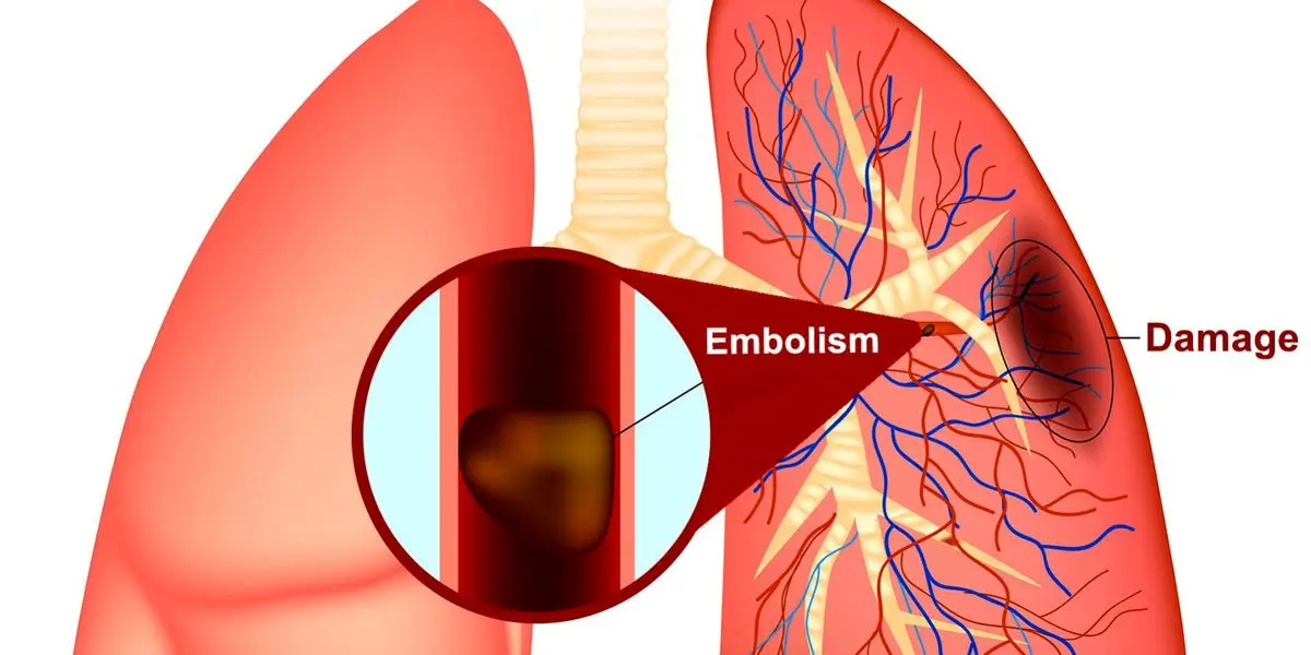 آیا این علائم را دارید؟ آمبولی ریه را جدی بگیرید! (اینفوگرافیک)