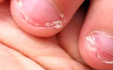 علل بروز اختلال جویدن ناخن