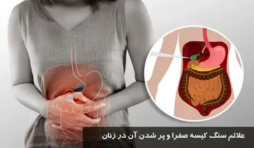 علائم سنگ کیسه صفرا در زنان + درمان خانگی مؤثر