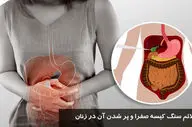 علائم سنگ کیسه صفرا در زنان + درمان خانگی مؤثر