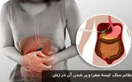 علائم سنگ کیسه صفرا در زنان + درمان خانگی مؤثر