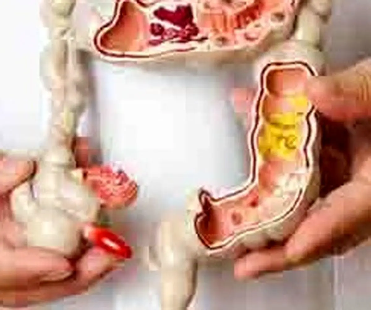  چگونه به سندرم روده چکه کن پی ببریم و راه های درمان آن