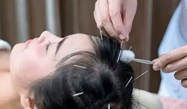 درمان ریزش مو با طب سوزنی؛ آیا ارزش امتحان کردن دارد؟