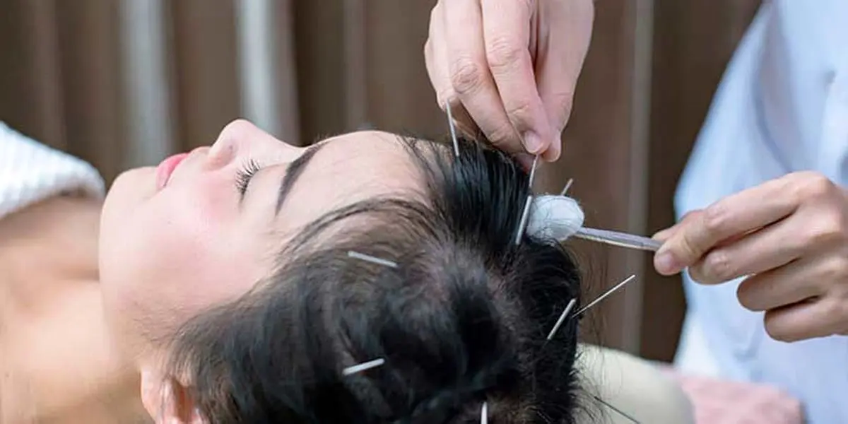 درمان ریزش مو با طب سوزنی؛ آیا ارزش امتحان کردن دارد؟