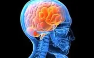  با عوامل خطر سکته مغزی آشنا شوید