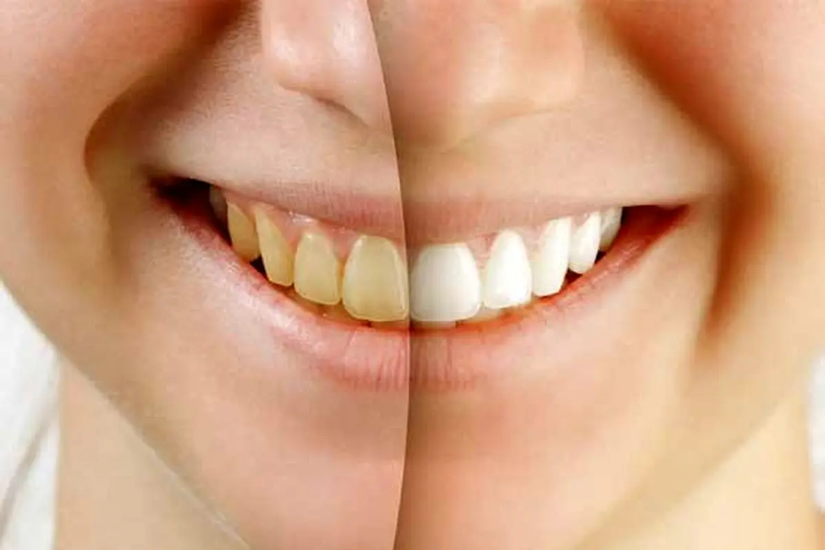  با این روش ها تا شب عید دندان هایتان را سفید کنید!