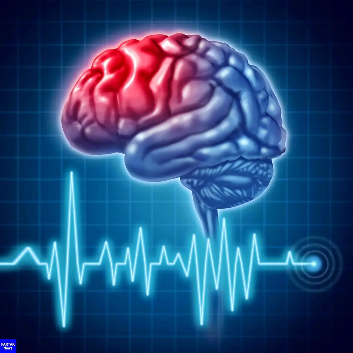  آینه‌درمانی، روش درمانی برای سکته مغزی