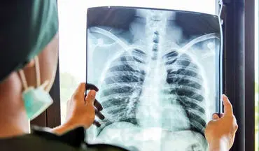 شناسایی ۱۷ مورد ابتلا به بیماری سل در شهرستان کاشان